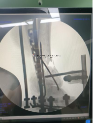 【最新病例】三臂十一軸機(jī)器人輔助器牽引——骨折外固定術(shù)骨折案例分享