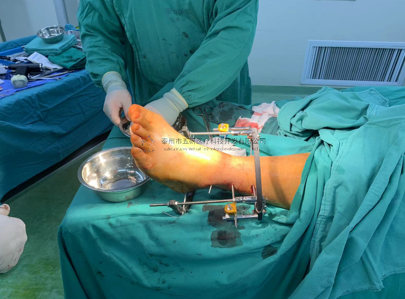 不開刀治骨折——CO接骨架典型病例分享